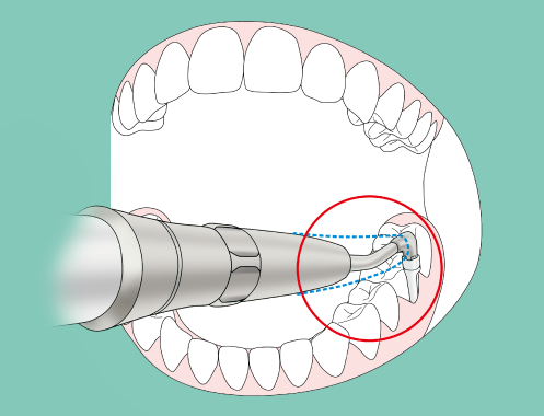 Slank dyse letter operation i de trange områder i mundhulen.